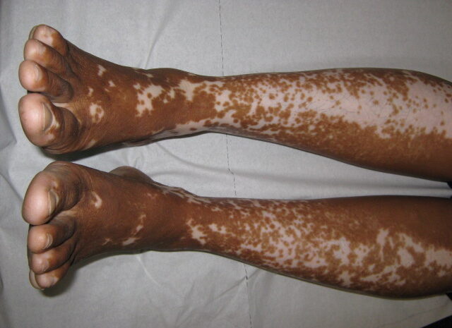  PESSOAS PORTADORAS DE VITILIGO, DOENÇA CARACTERIZADA PELA DESPIGMENTAÇÃO DA PELE DEVIDO À AUSÊNCIA …